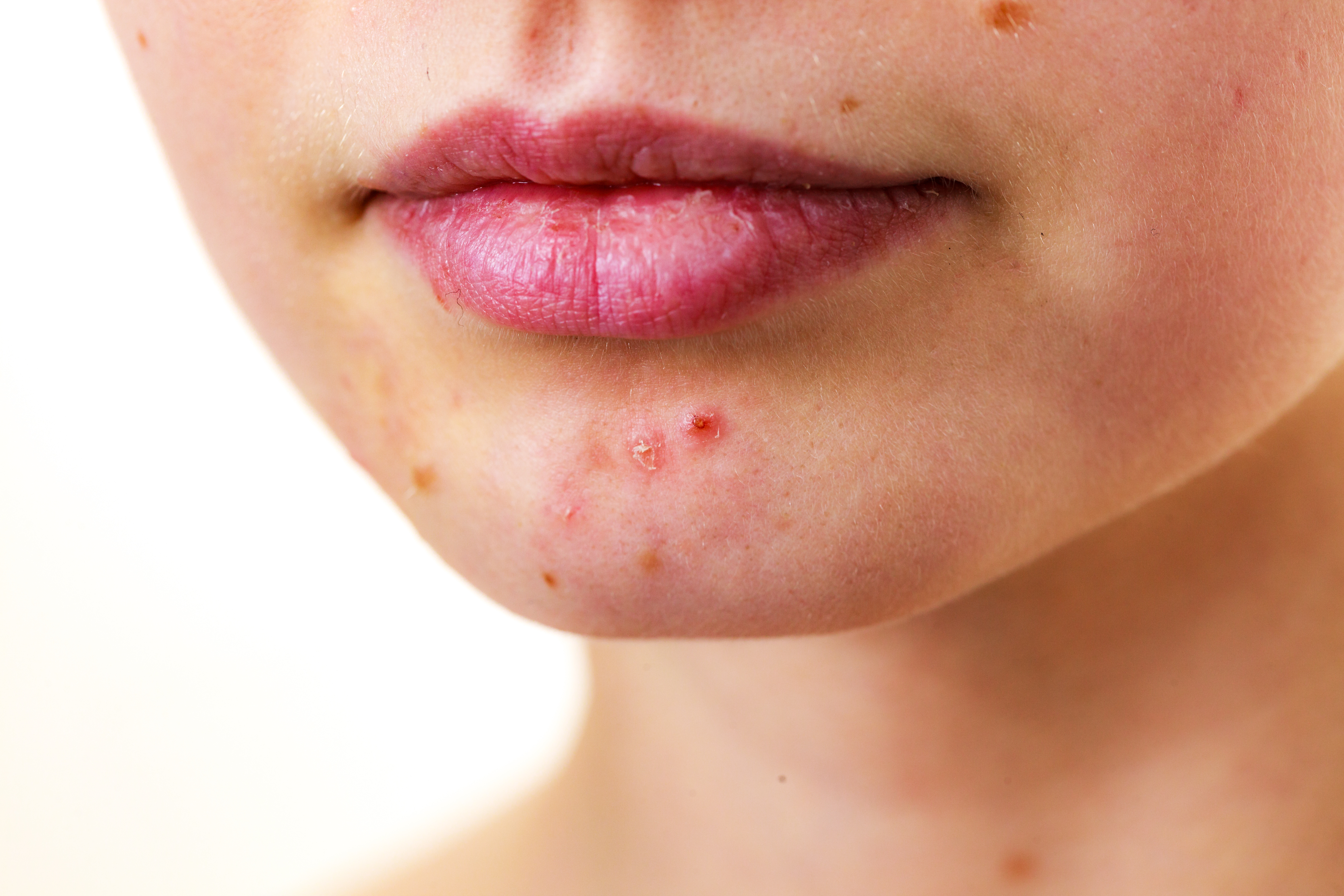 Ácido salicílico e a acne: qual é a sua eficácia?